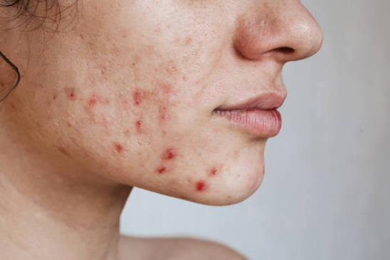 ACNE